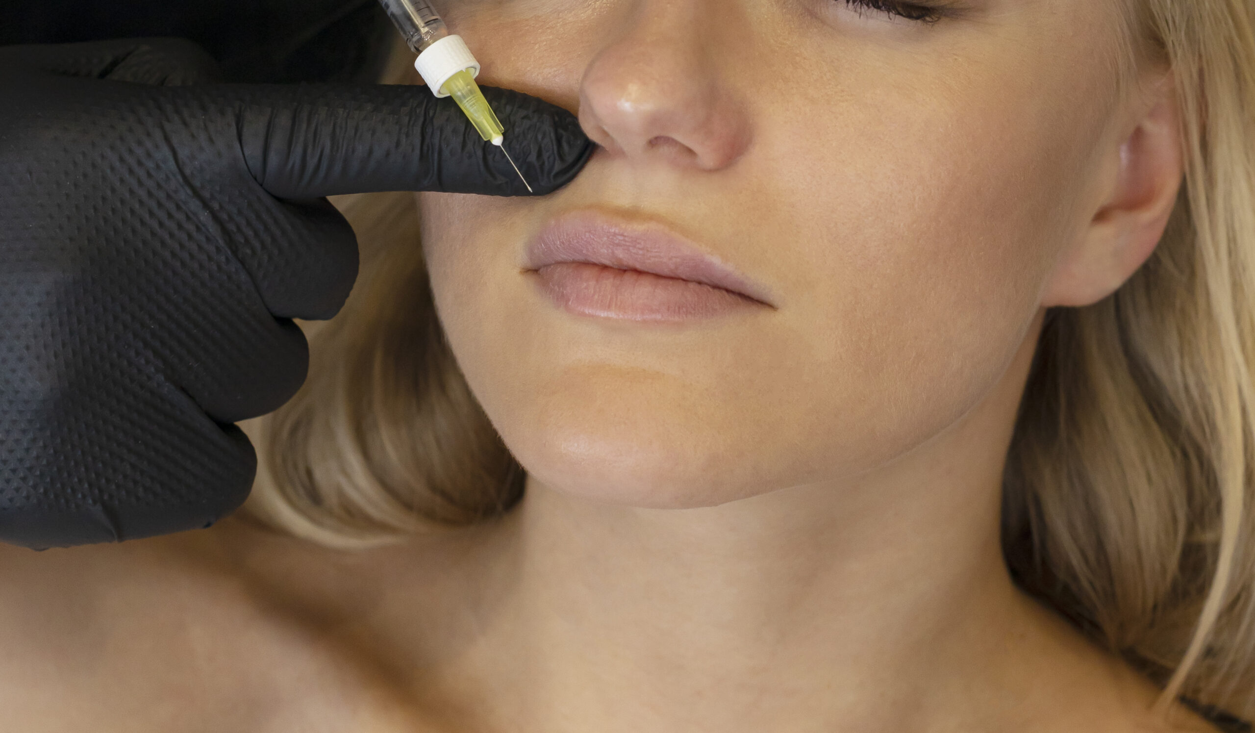 Closeup cropped female face with augmented lips with filler, injection. White woman lying on couch. Beauty physician holds syringe near girl's face. Adding volume to lip procedure. Aesthetic medicine